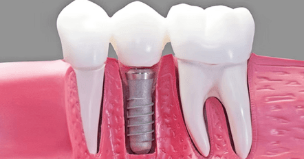 Cross-section of a dental implant placed in the jawbone between natural teeth