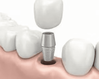 Dental implant with crown being placed on the abutment