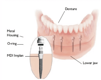 Mini dental implants (MDI) stabilizing a lower denture