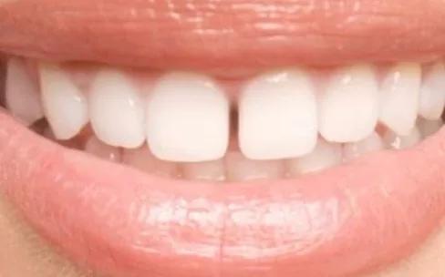 Before treatment