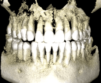 3D CT scan rendering of jaw and teeth structure